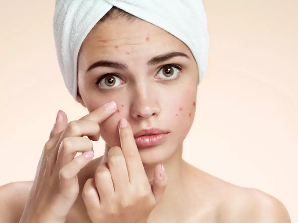 What Your Acne Is Trying To Tell You About Your Health – 2023 Guide