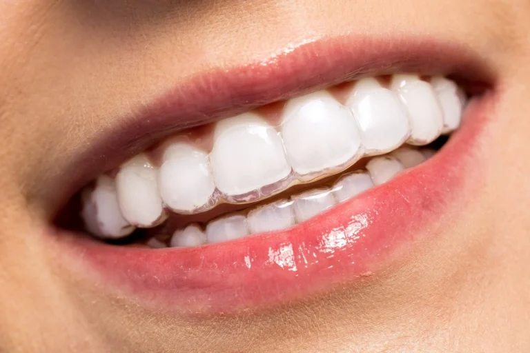 Are Impress Clear Aligners Your Ideal Orthodontic Treatment?